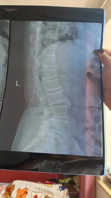 卫健委回应老人术后体内残留40cm导丝 卫健委回应老人术后体内残留40cm导丝